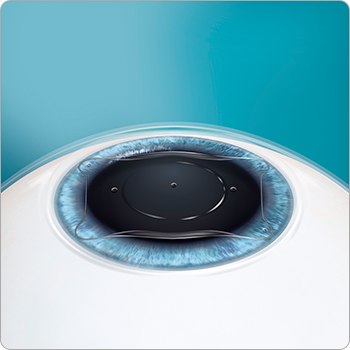 ICL（眼内コンタクトレンズ）手術の流れ